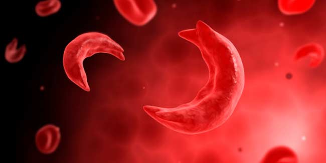 Sickle Cell
