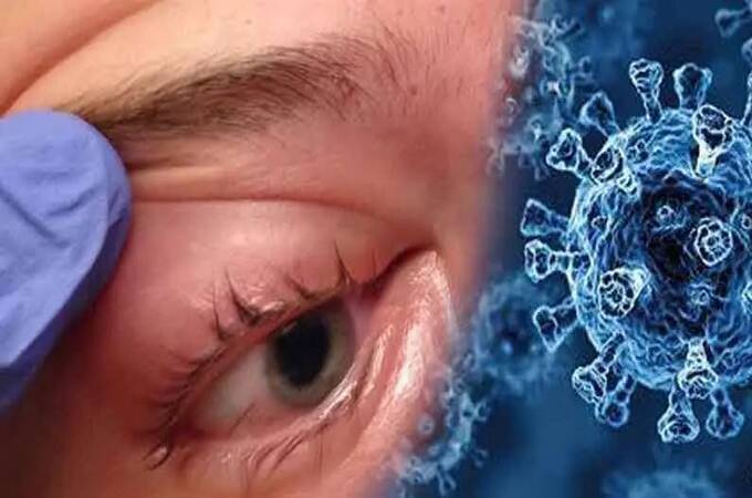 कोविडमधून बरे झाल्यानंतर १० रुग्णांमध्ये म्युकरमायकोसिसची लागण