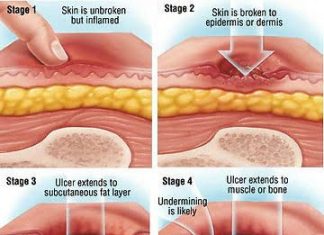 Wockhardt Education Initiative: How Pressure Ulcers (Bed Sore) kills patients Wockhardt Education Initiative: How Pressure Ulcers (Bed Sore) kills patients