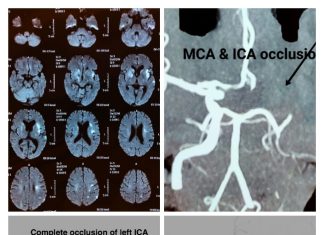 Mechanical thrombectomy after 16 hours in acute ischemic stroke at Wockhardt Hospital, Nagpur Mechanical thrombectomy after 16 hours in acute ischemic stroke at Wockhardt Hospital, Nagpur
