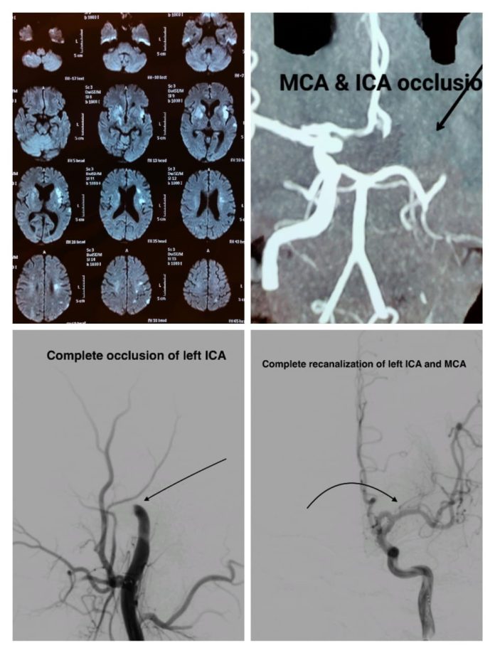 Mechanical thrombectomy after 16 hours in acute ischemic stroke at Wockhardt Hospital, Nagpur