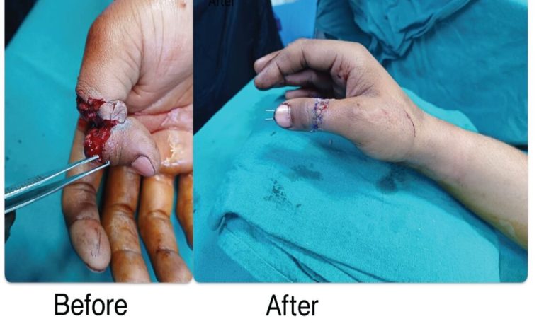 Complex Thumb Re-plantation Surgery at Krims Hospital – A Remarkable Medical Achievement